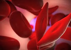 Sickle cell