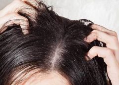dandruff and winter