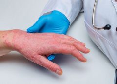 skin and rash